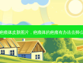 疤痕体皮肤图片，疤痕体的疤痕有办法去掉么