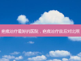疤痕治疗 *** 的医院，疤痕治疗前后对比照