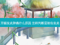 牙龈发炎肿痛什么原因 怎样判断是智齿发炎