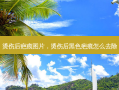 烫伤后疤痕图片，烫伤后黑色疤痕怎么去除